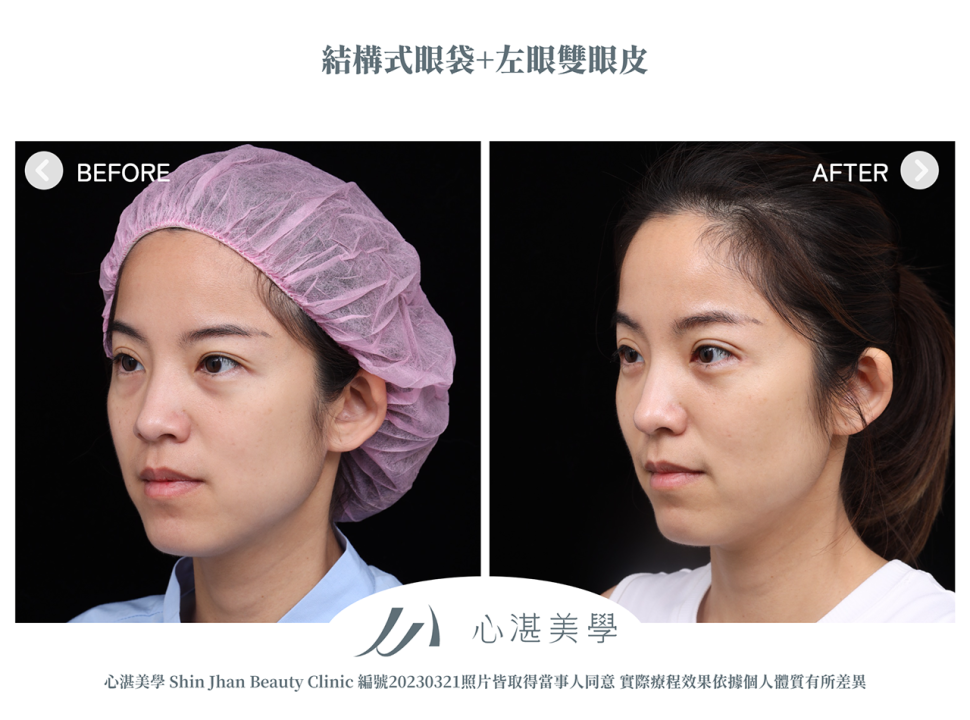 結構式眼袋+割左眼單眼皮改善兩側雙眼皮不對稱案例分享
