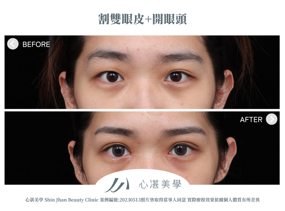 割雙眼皮+開眼頭改善兩側雙眼皮不對稱案例分享
