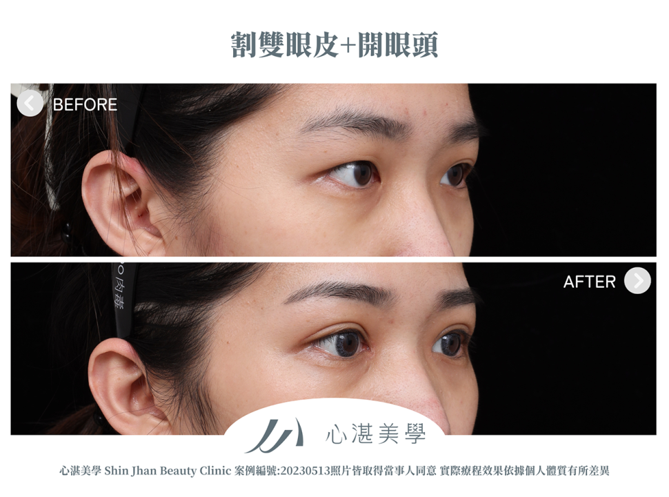 割雙眼皮+開眼頭改善兩側雙眼皮不對稱案例分享