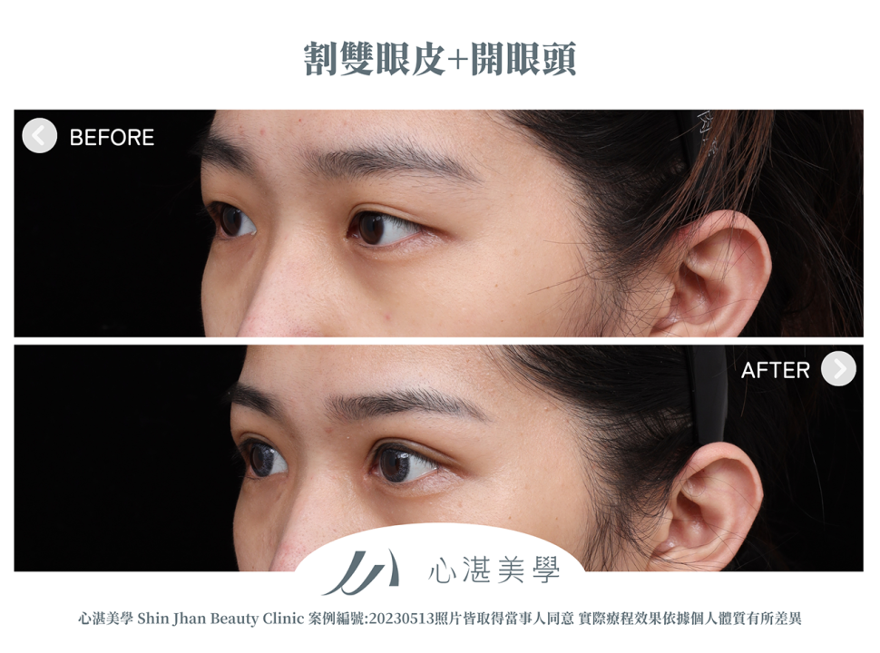 割雙眼皮+開眼頭改善兩側雙眼皮不對稱案例分享