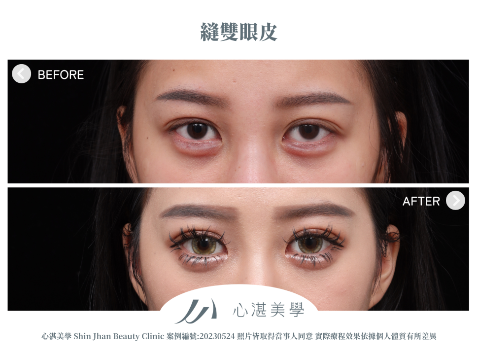 縫雙眼皮案例分享