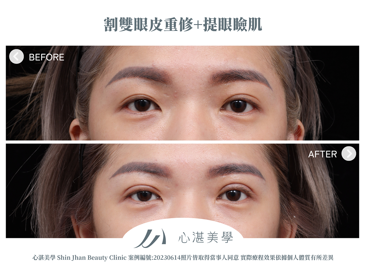 雙眼皮重修+提眼瞼肌改善雙眼雙眼皮寬度不對稱與雙眼無神案例分享