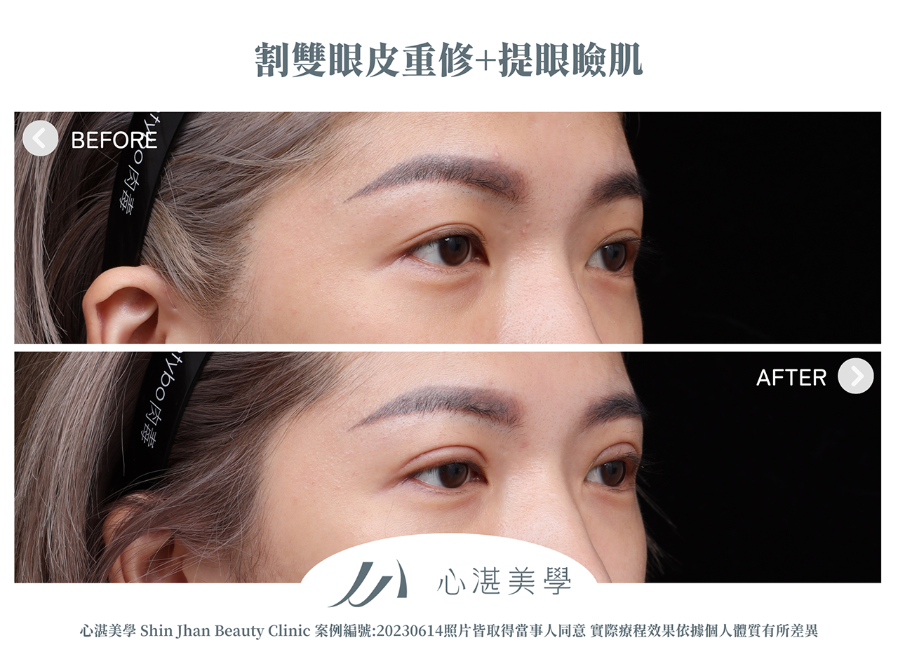 雙眼皮重修+提眼瞼肌改善雙眼雙眼皮寬度不對稱與雙眼無神案例分享