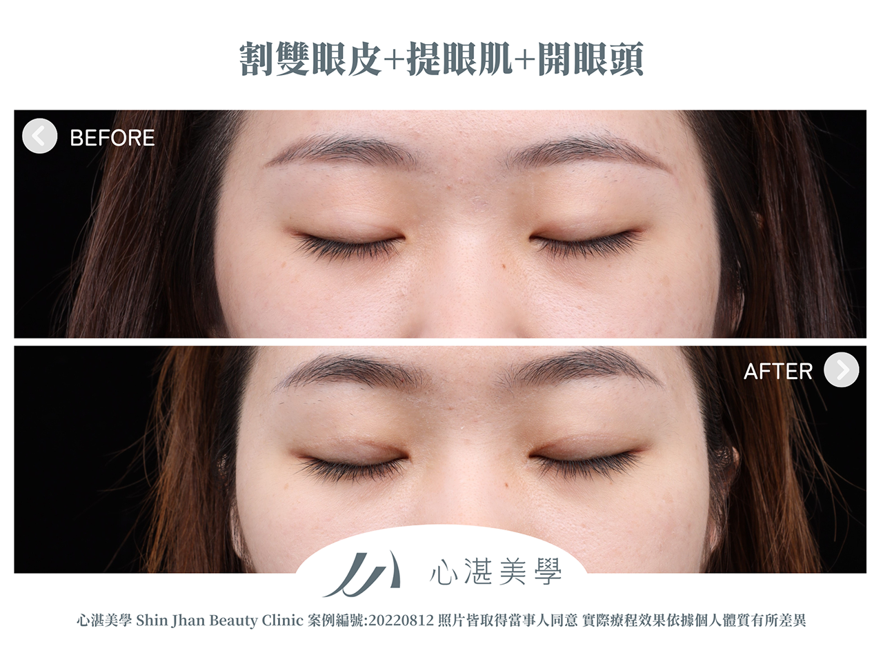 割雙眼皮+提眼瞼肌+開眼頭案例分享