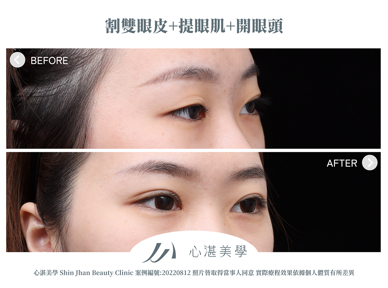 割雙眼皮+提眼瞼肌+開眼頭案例分享