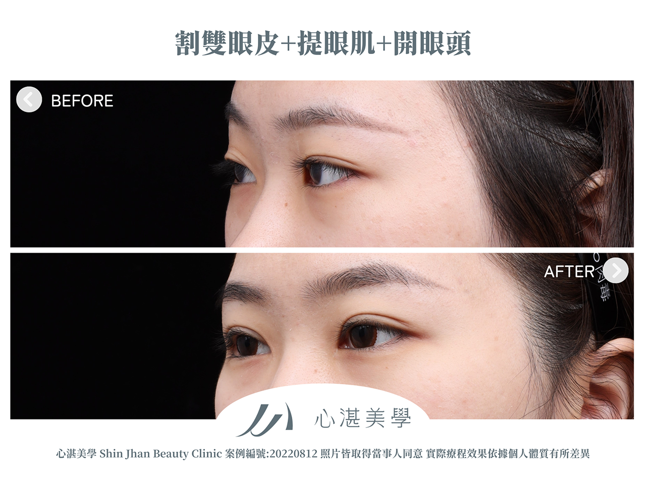 割雙眼皮+提眼瞼肌+開眼頭案例分享