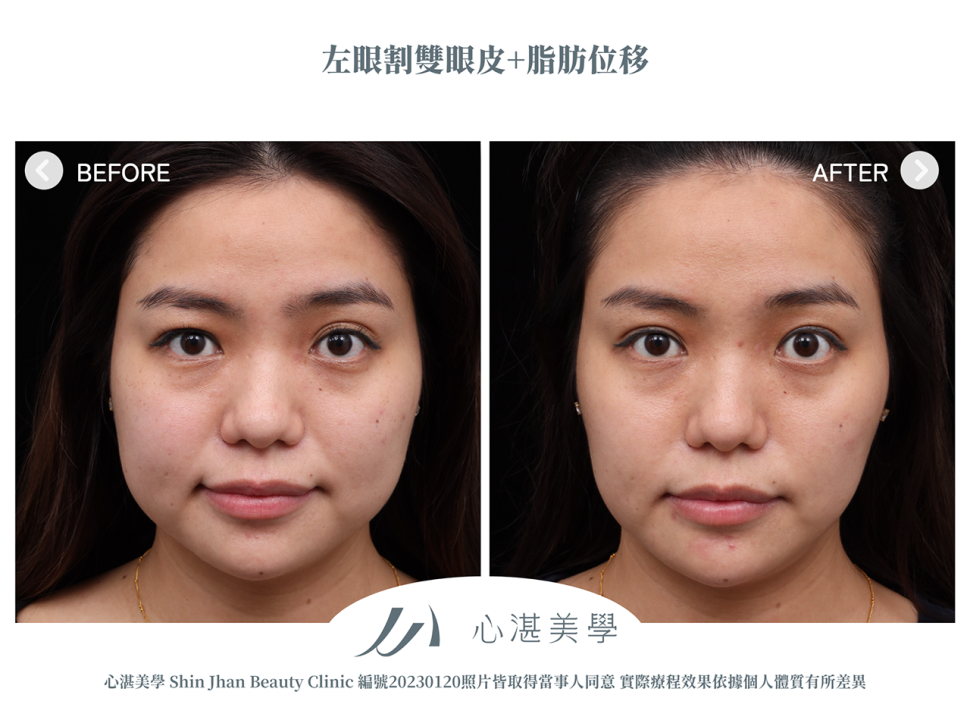 單眼割雙眼皮+脂肪轉位改善眼窩凹陷造成的多褶眼皮與大小眼案例分享