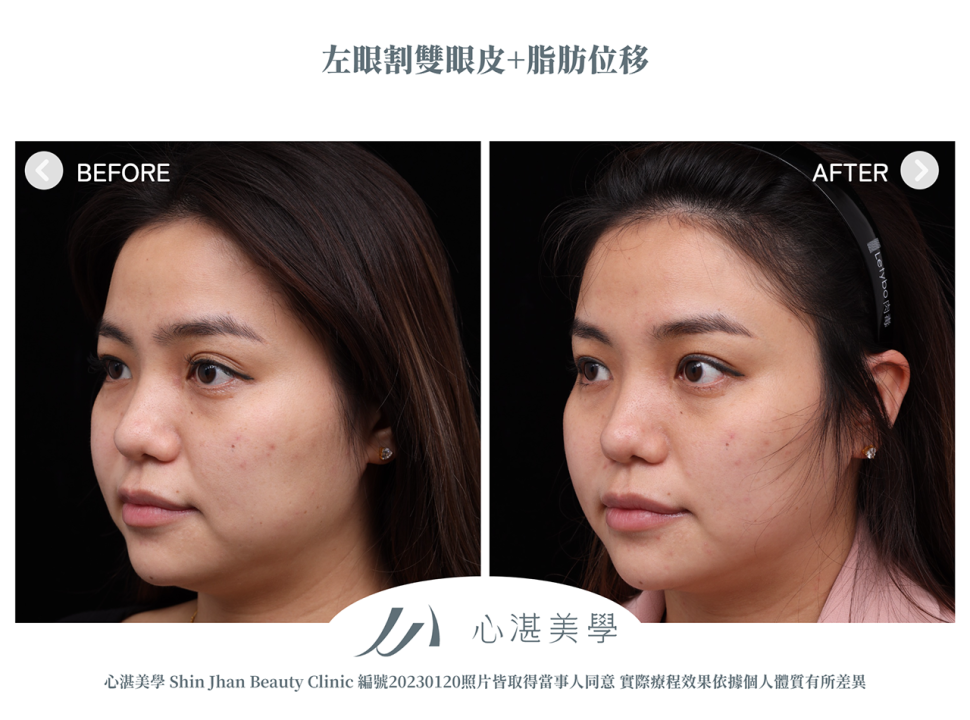 單眼割雙眼皮+脂肪轉位改善眼窩凹陷造成的多褶眼皮與大小眼案例分享