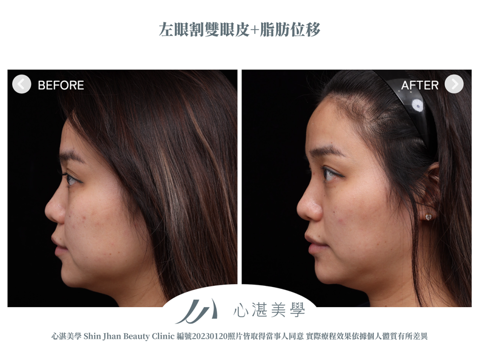 單眼割雙眼皮+脂肪轉位改善眼窩凹陷造成的多褶眼皮與大小眼案例分享