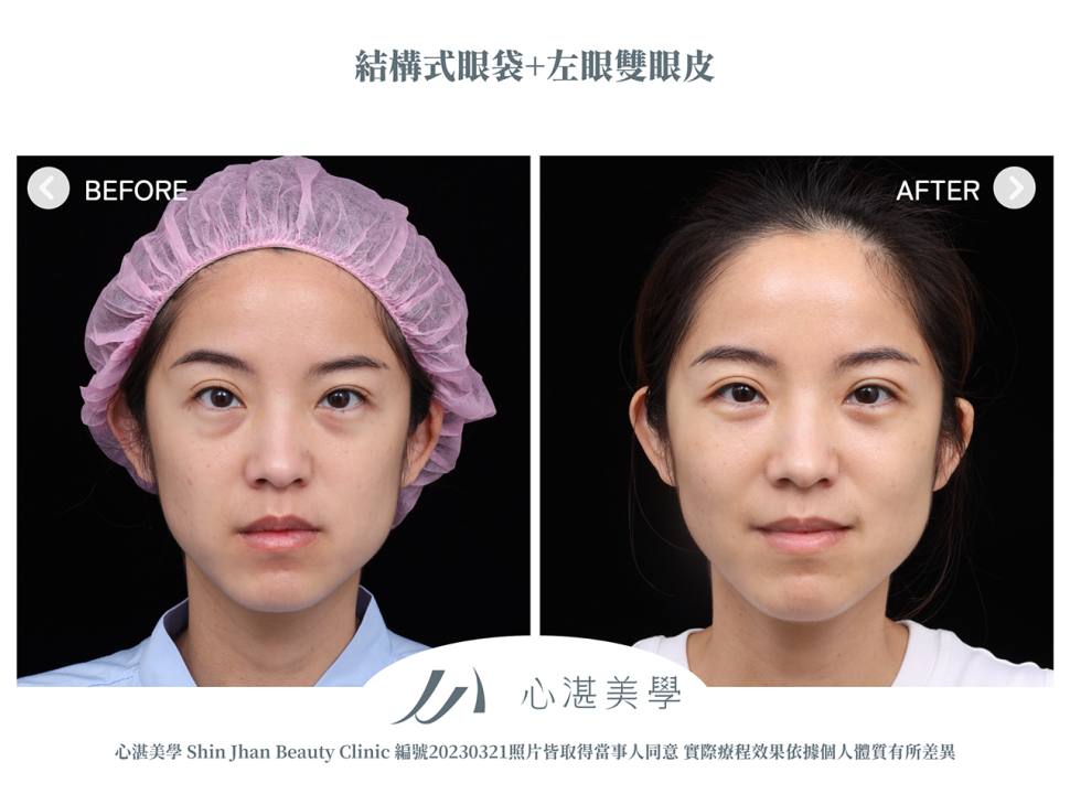 結構式眼袋+割左眼單眼皮改善兩側雙眼皮不對稱案例分享