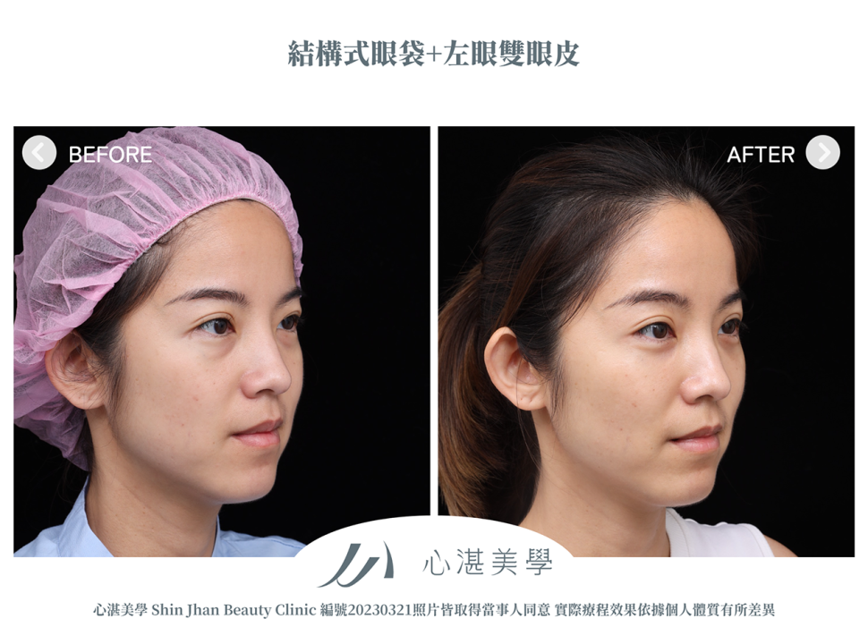 結構式眼袋+割左眼單眼皮改善兩側雙眼皮不對稱案例分享
