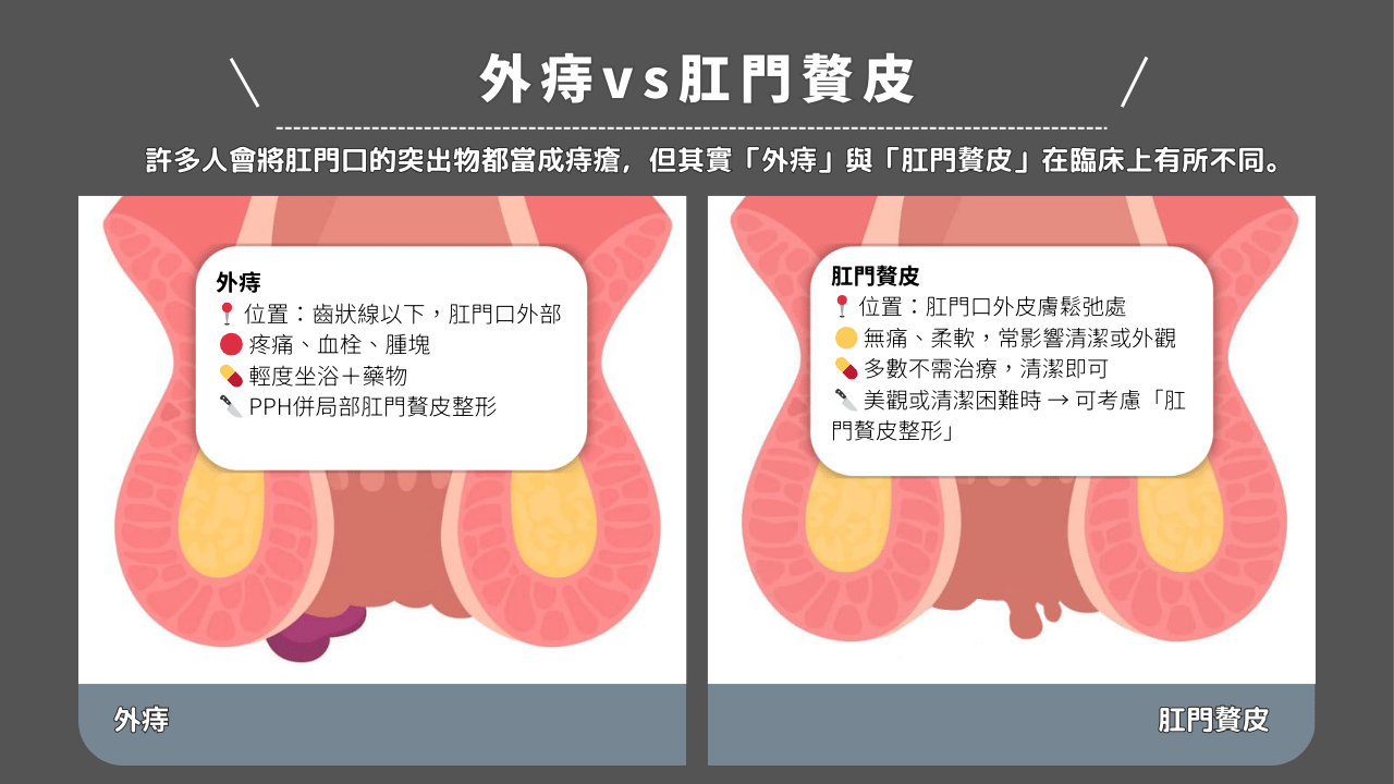 許多人會將肛門口的突出物都當成痔瘡，但其實「外痔」與「肛門贅皮」在臨床上有所不同。