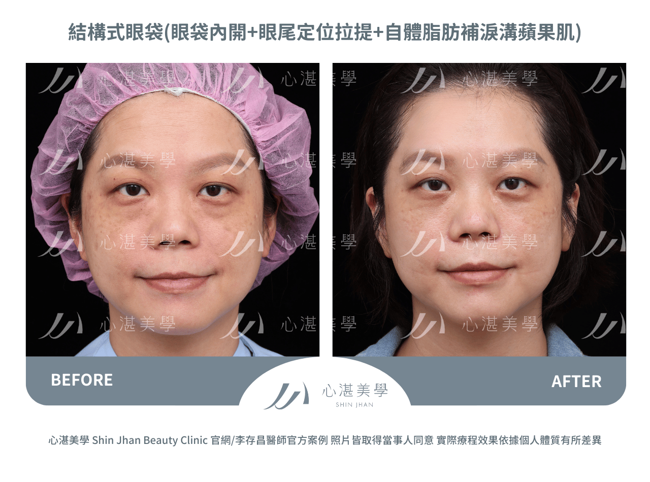 眼袋內開+自體脂肪補淚溝、內側蘋果肌+眼尾拉提定位術前術後案例分享照