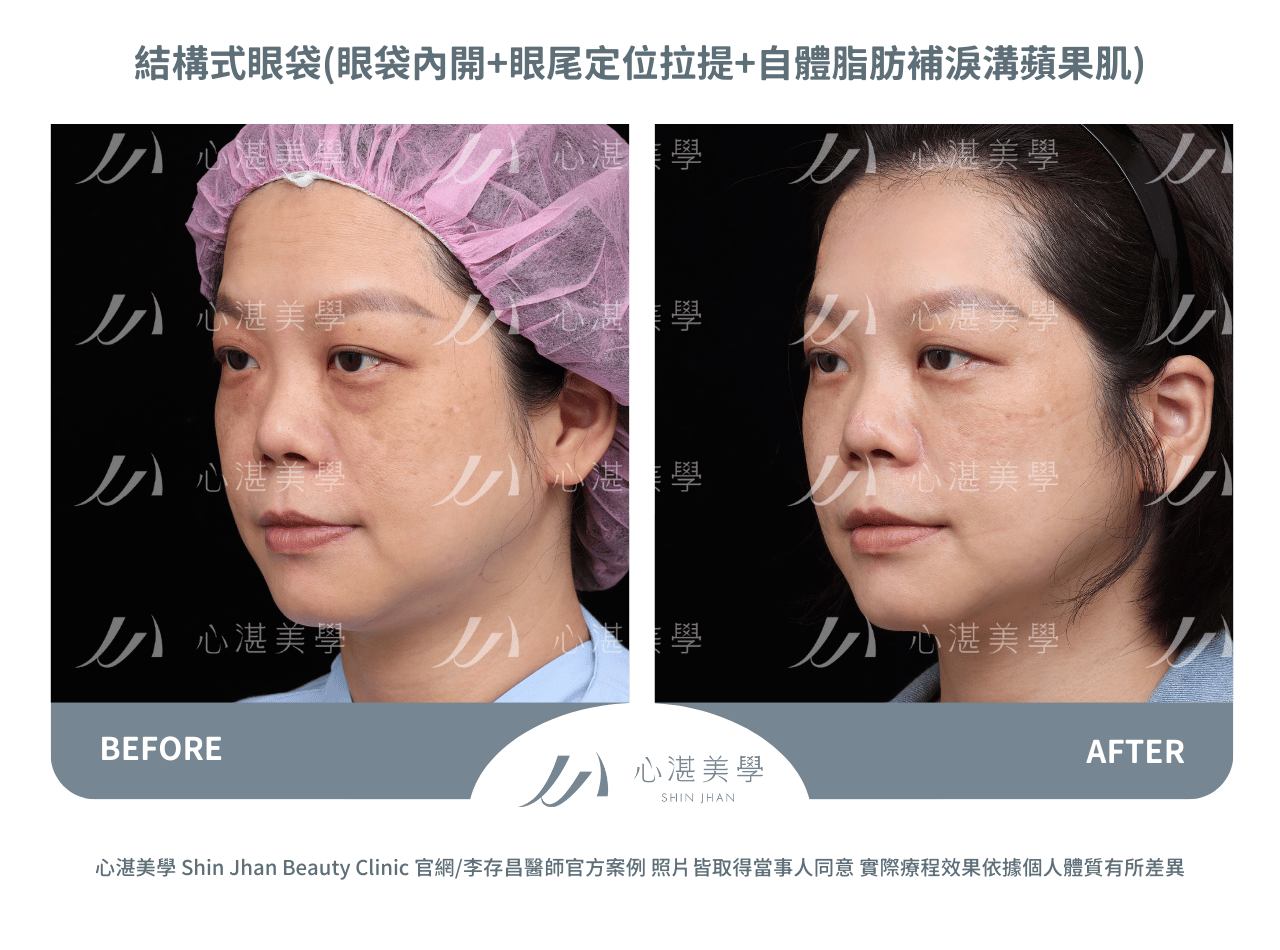 眼袋內開+自體脂肪補淚溝、內側蘋果肌+眼尾拉提定位術前術後案例分享照