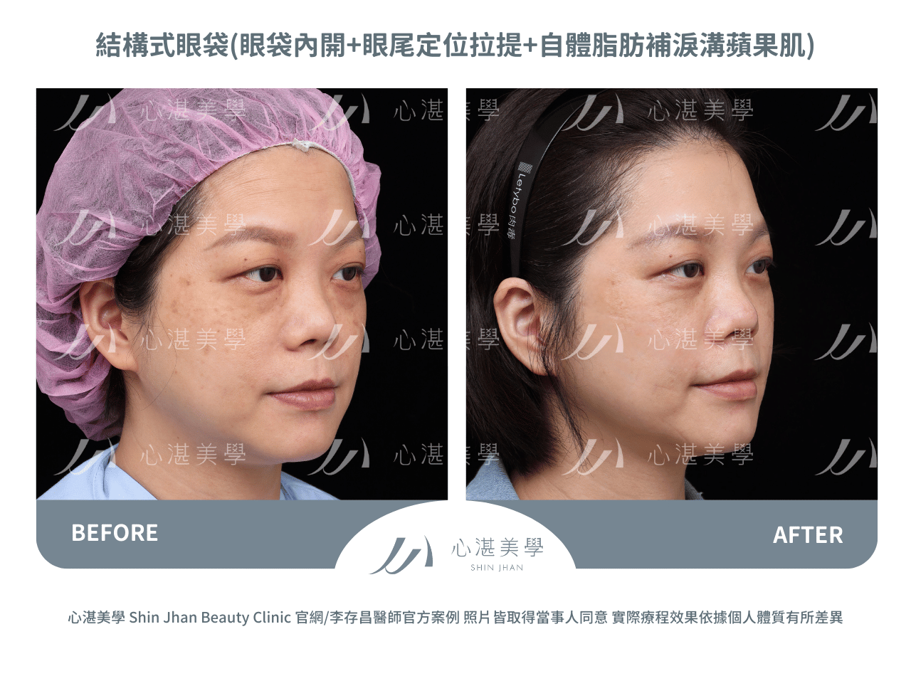 眼袋內開+自體脂肪補淚溝、內側蘋果肌+眼尾拉提定位術前術後案例分享照