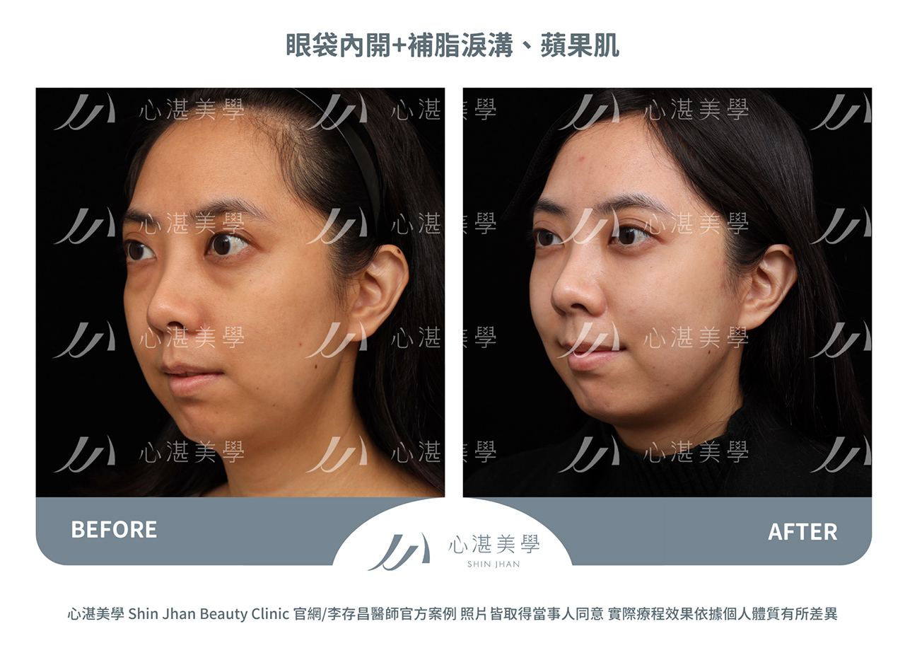 眼袋內開+自體脂肪補淚溝、內側蘋果肌術前術後案例分享照