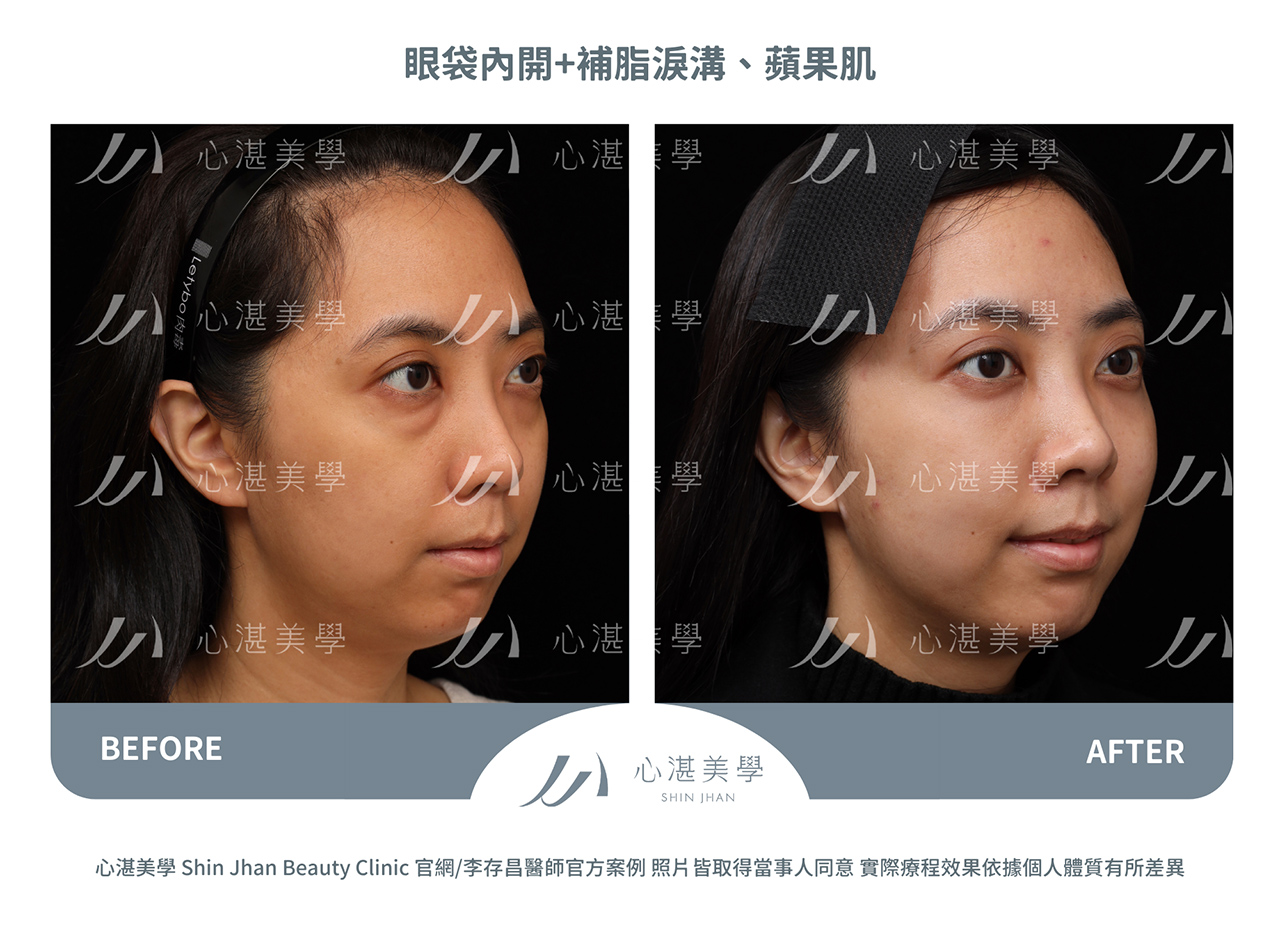 眼袋內開+自體脂肪補淚溝、內側蘋果肌術前術後案例分享照