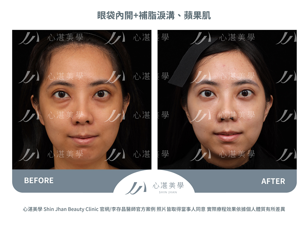 眼袋內開+自體脂肪補淚溝、內側蘋果肌術前術後案例分享照