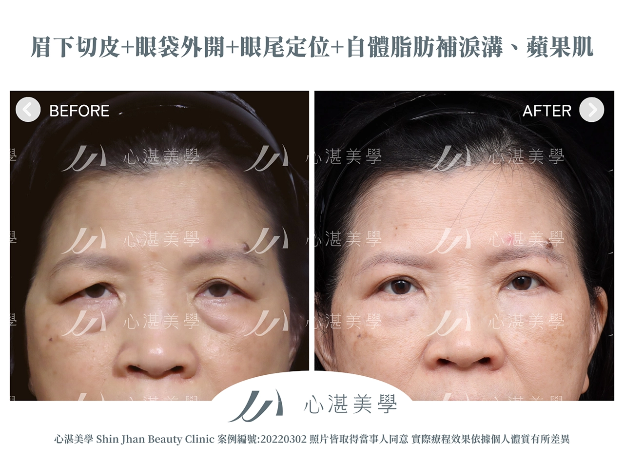 眉下切(提眉手術)+眼袋外開+脂肪補淚溝+眼尾拉提定位手術案例術前術後對比