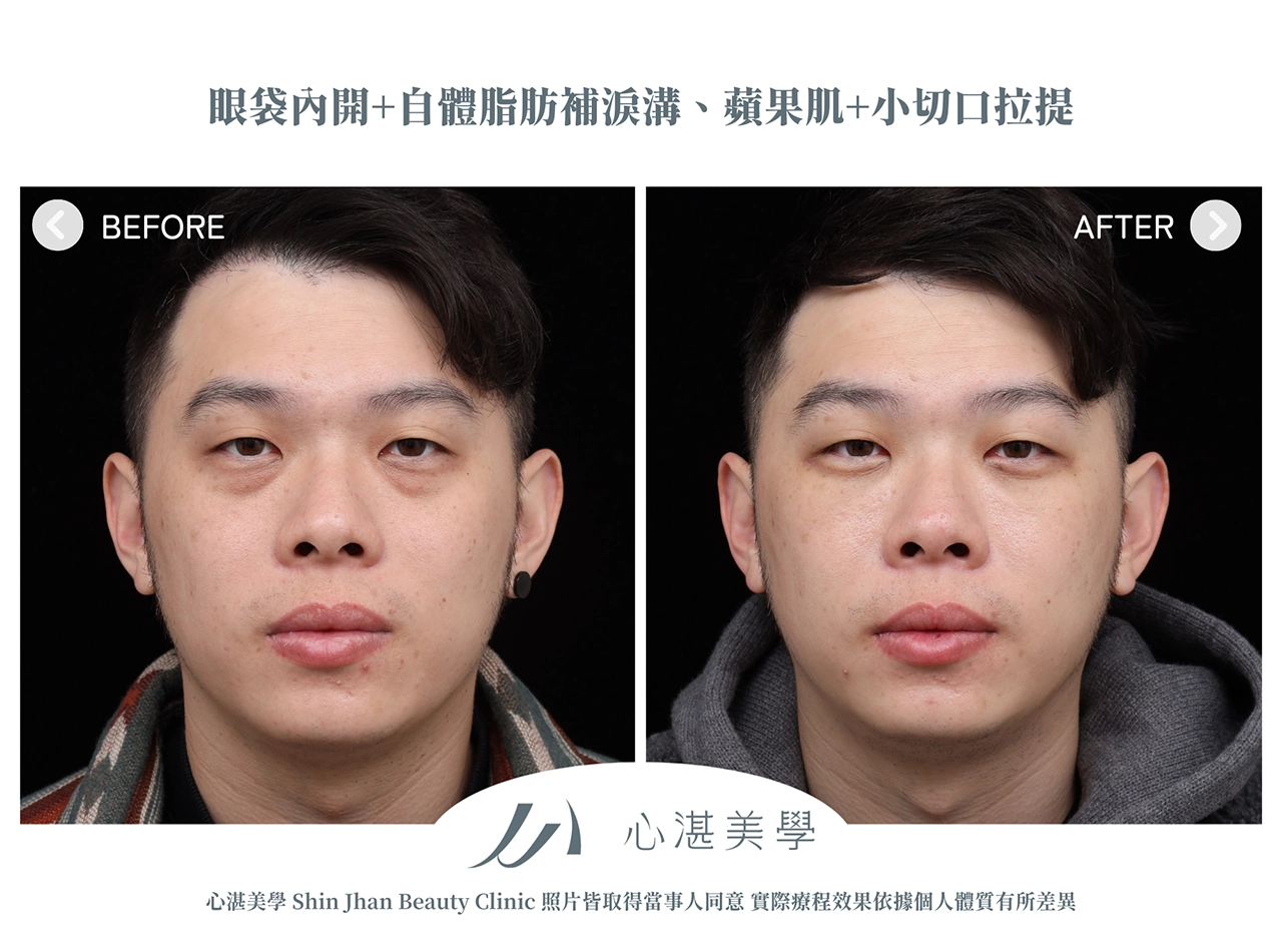眼袋內開+脂肪補淚溝+眼尾拉提定位(結構式眼袋)手術案例術前術後對比