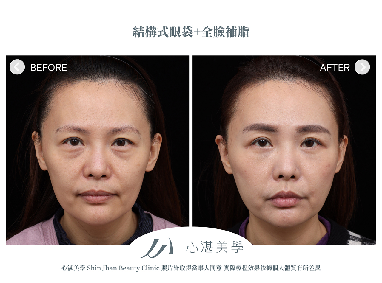 眼袋內開+全臉補脂肪+眼尾拉提定位(結構式眼袋)手術案例術前術後對比