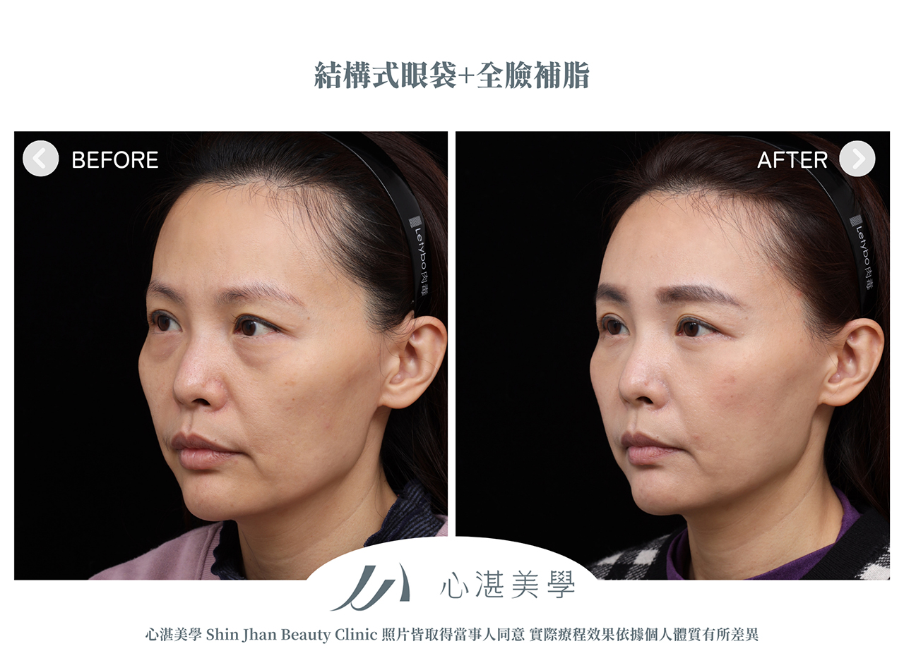 眼袋內開+全臉補脂肪+眼尾拉提定位(結構式眼袋)手術案例術前術後對比