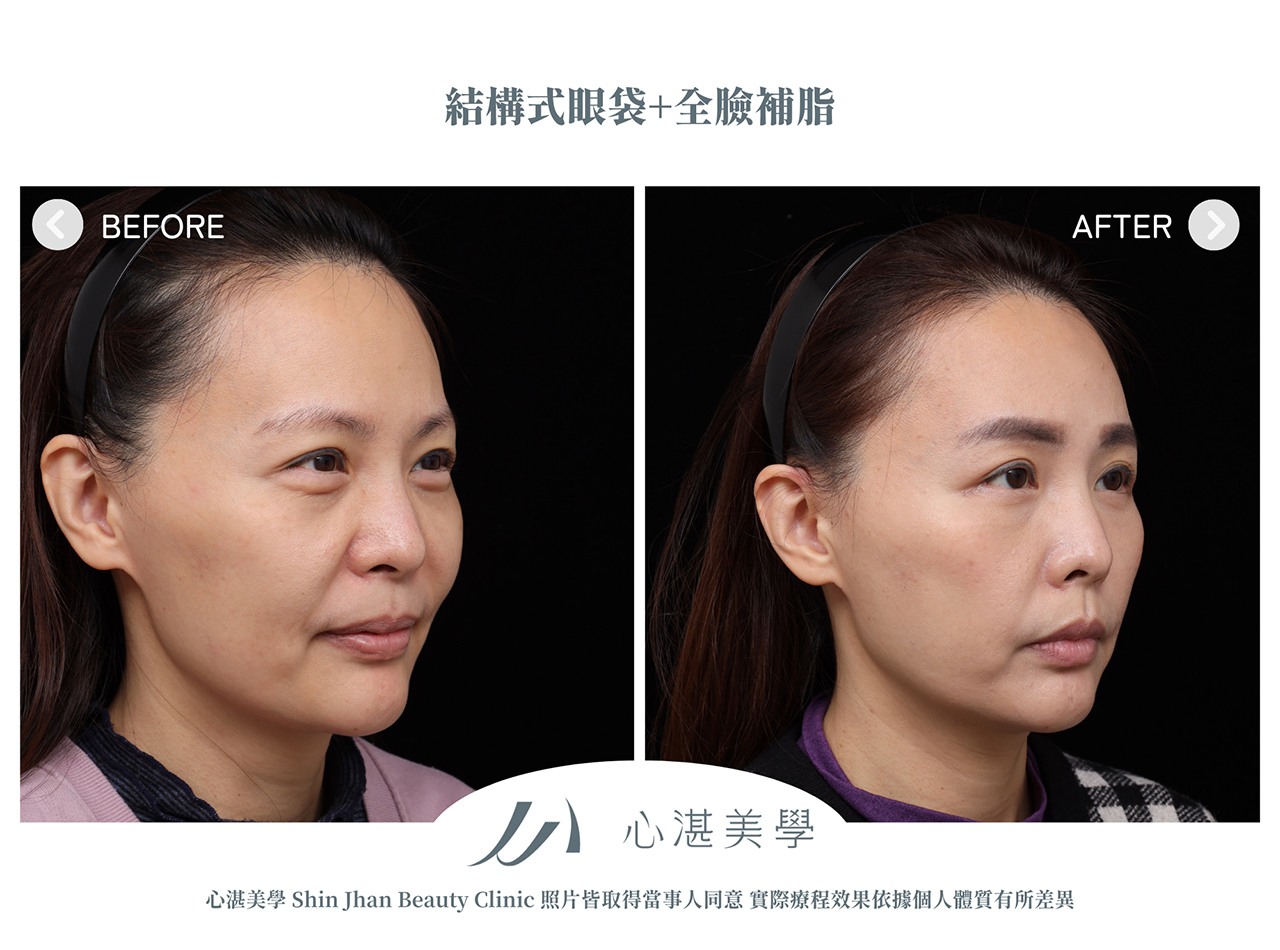 眼袋內開+全臉補脂肪+眼尾拉提定位(結構式眼袋)手術案例術前術後對比
