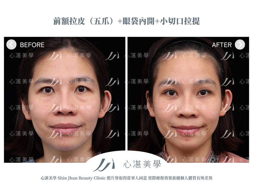 內視鏡前額拉皮+眼袋內開+眼尾拉提定位(結構式眼袋)手術案例術前術後對比