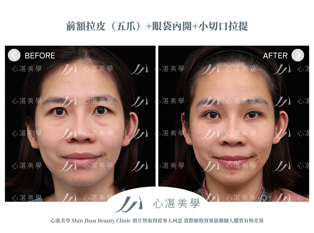 內視鏡前額拉皮+眼袋內開+眼尾拉提定位(結構式眼袋)手術案例術前術後對比