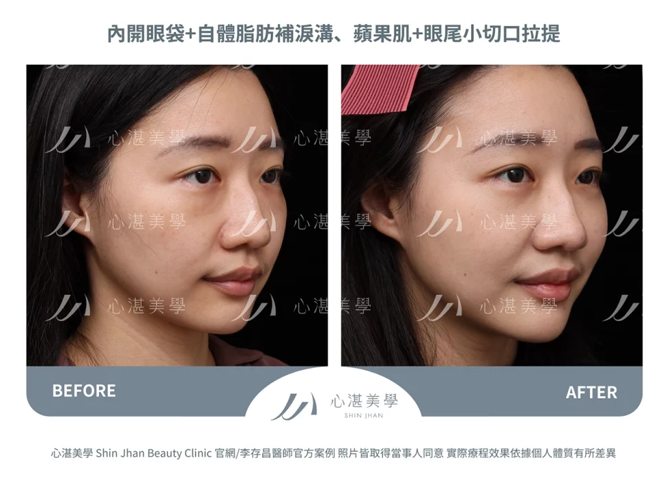 眼袋內開+脂肪補淚溝+眼尾拉提定位(結構式眼袋)手術案例術前術後對比