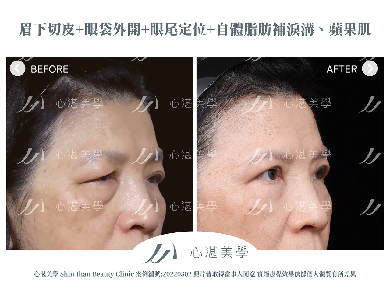 眉下切(提眉手術)+眼袋外開+脂肪補淚溝+眼尾拉提定位手術案例術前術後對比