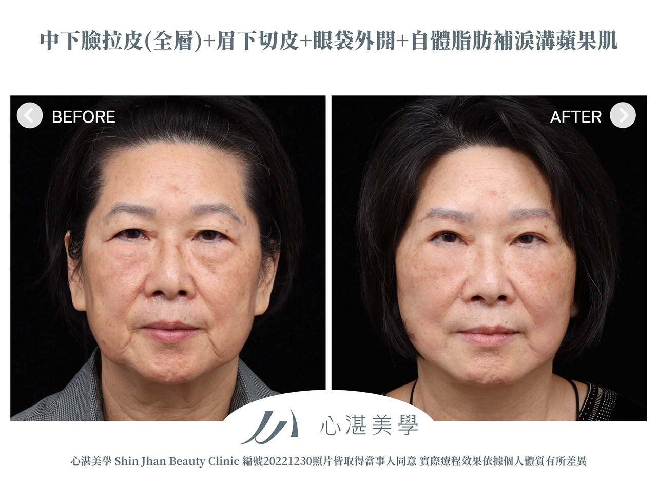 中下臉拉皮+眉下切(提眉手術)+眼袋外開+脂肪補淚溝+眼尾拉提定位手術案例術前術後對比