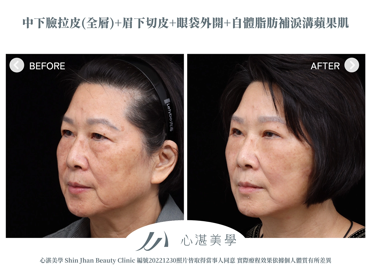 中下臉拉皮+眉下切(提眉手術)+眼袋外開+脂肪補淚溝+眼尾拉提定位手術案例術前術後對比