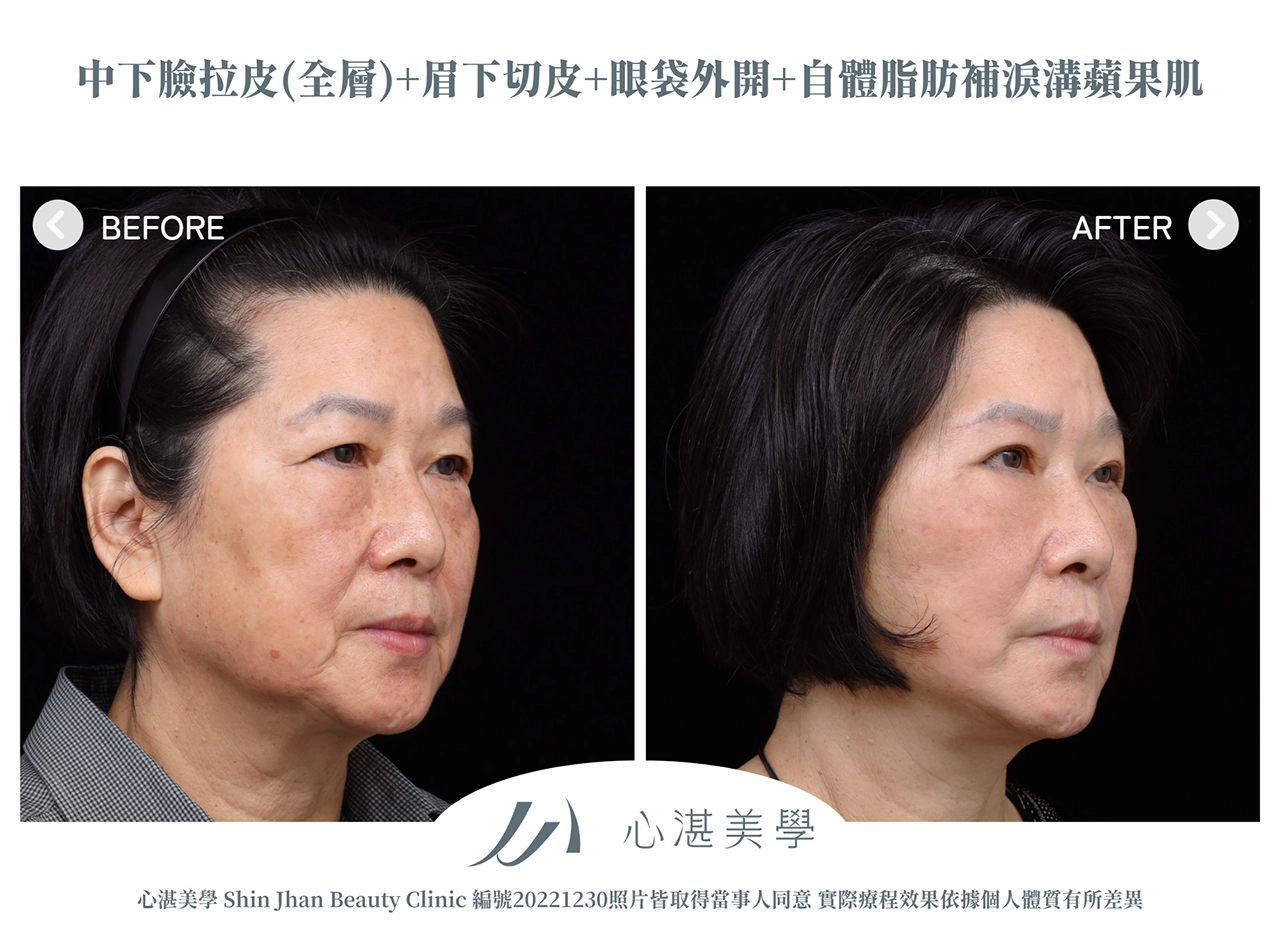 中下臉拉皮+眉下切(提眉手術)+眼袋外開+脂肪補淚溝+眼尾拉提定位手術案例術前術後對比