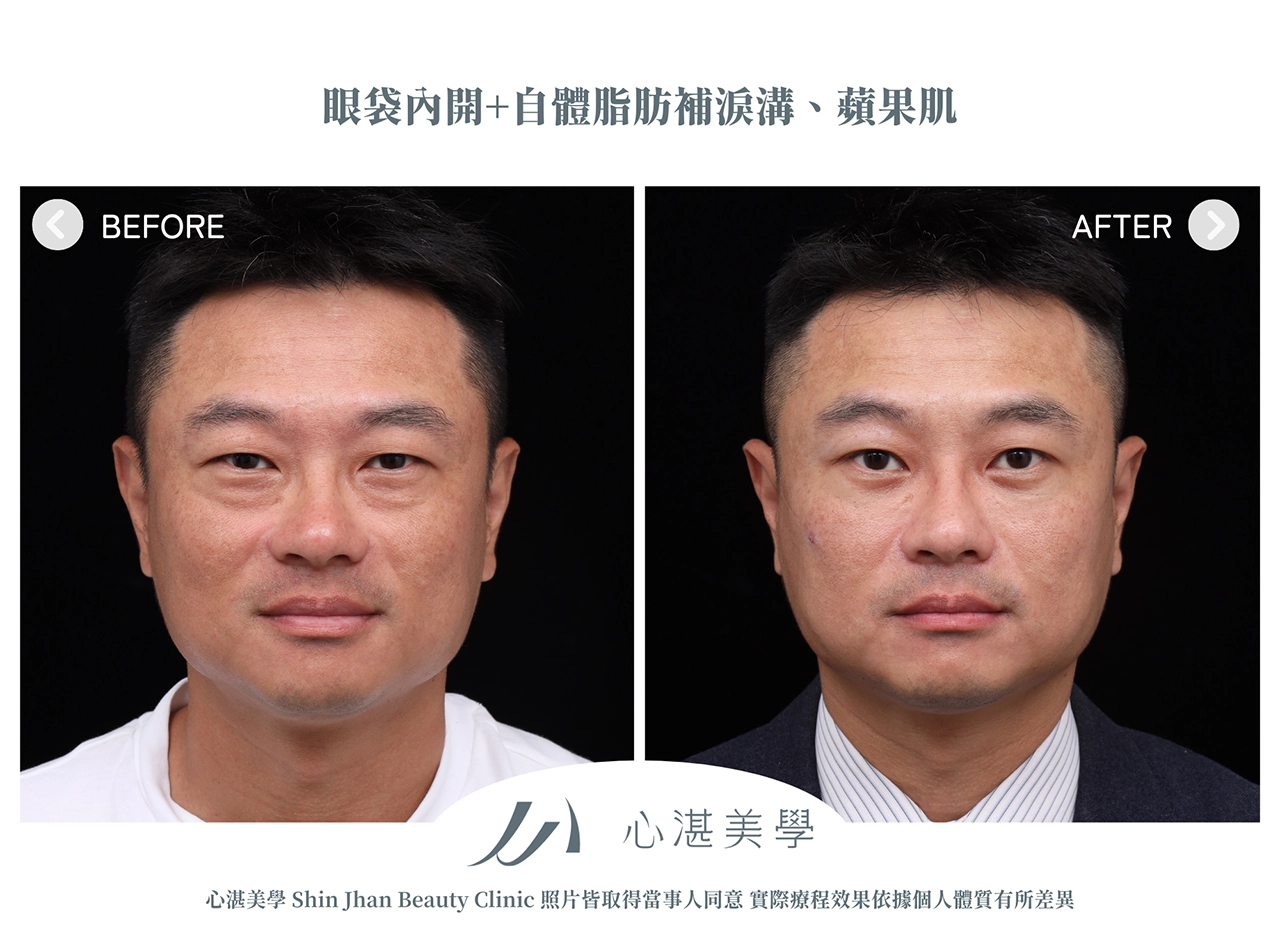 眼袋內開+脂肪補淚溝手術案例術前術後對比