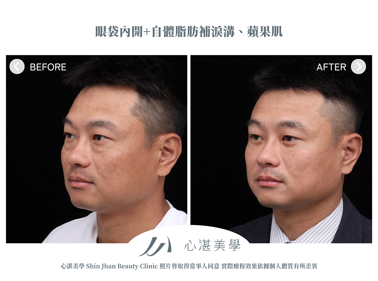 眼袋內開+脂肪補淚溝手術案例術前術後對比