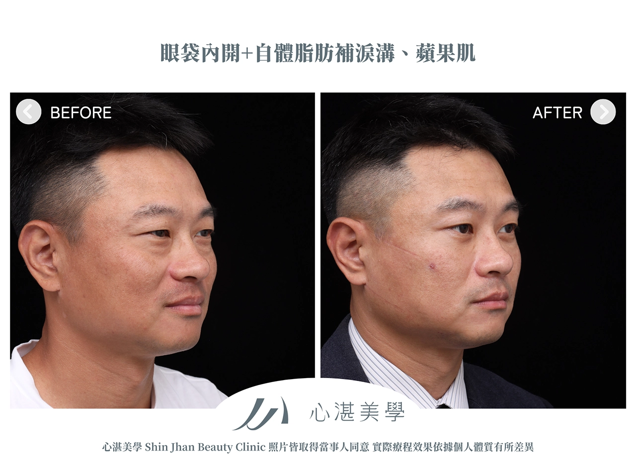 眼袋內開+脂肪補淚溝手術案例術前術後對比