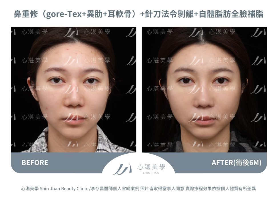 隆鼻重修＋針刀無痕法令紋平滑術＋自體脂肪補臉