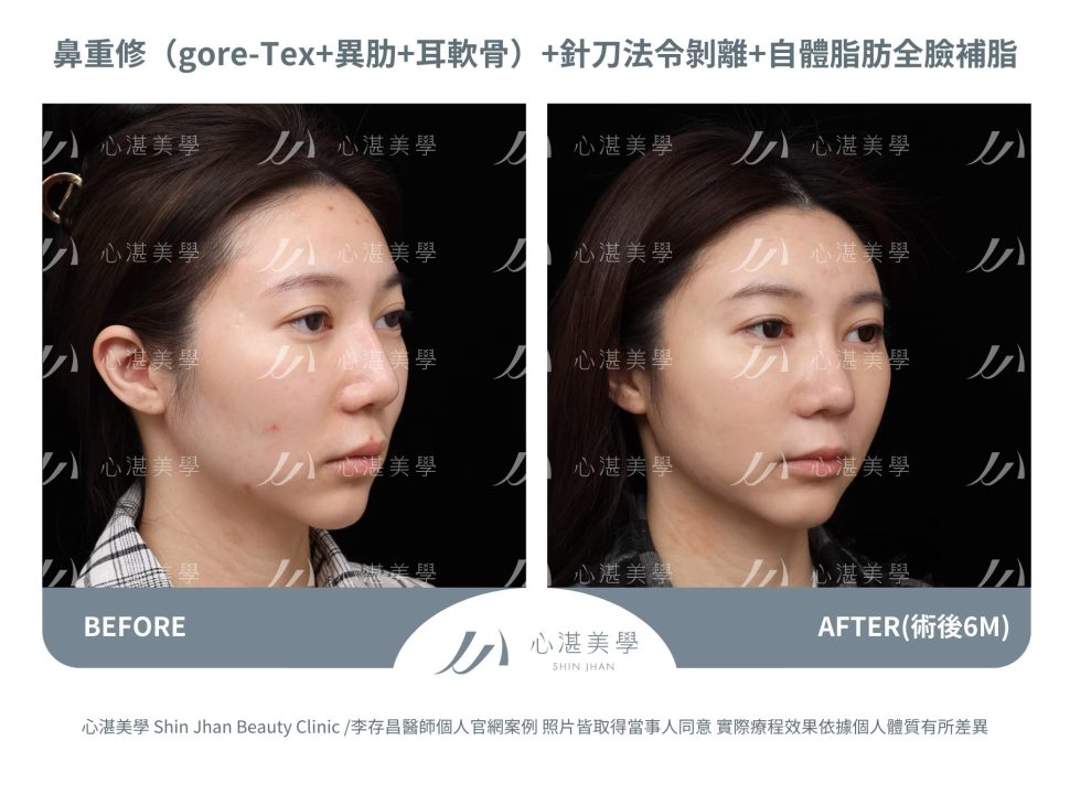 隆鼻重修＋針刀無痕法令紋平滑術＋自體脂肪補臉