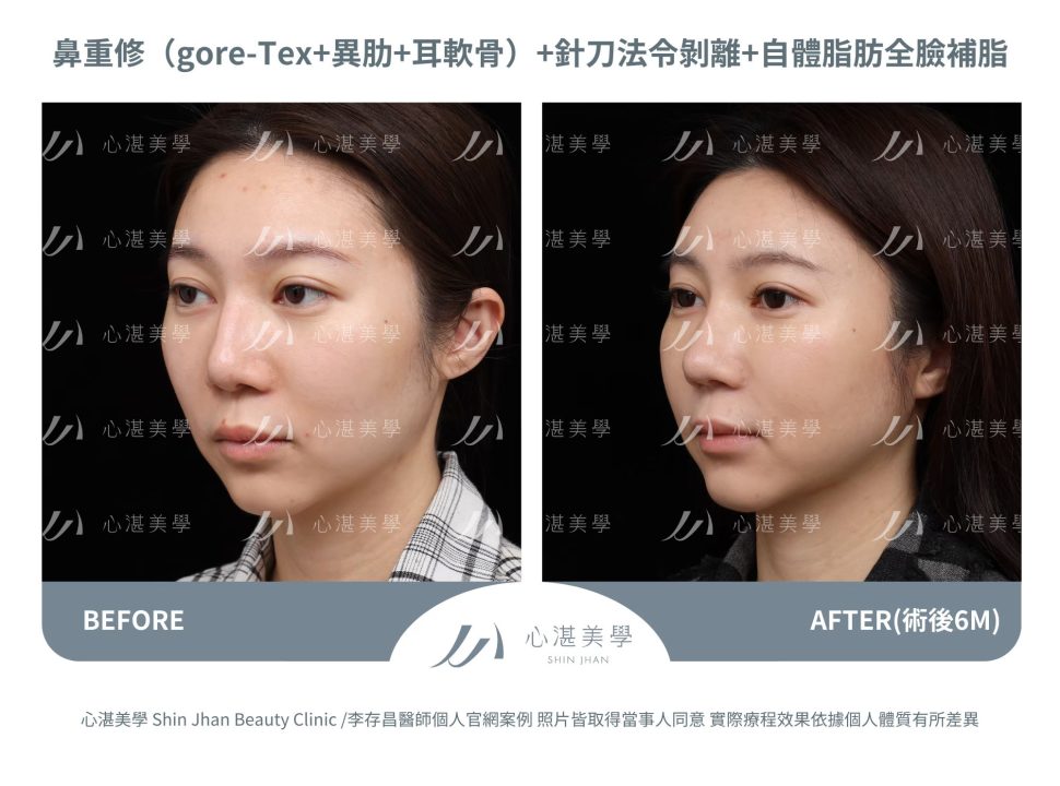 隆鼻重修＋針刀無痕法令紋平滑術＋自體脂肪補臉