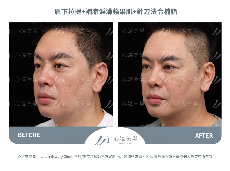 針刀無痕法令紋平滑術＋自體脂肪補淚溝＋微創提眉手術（眉下切）