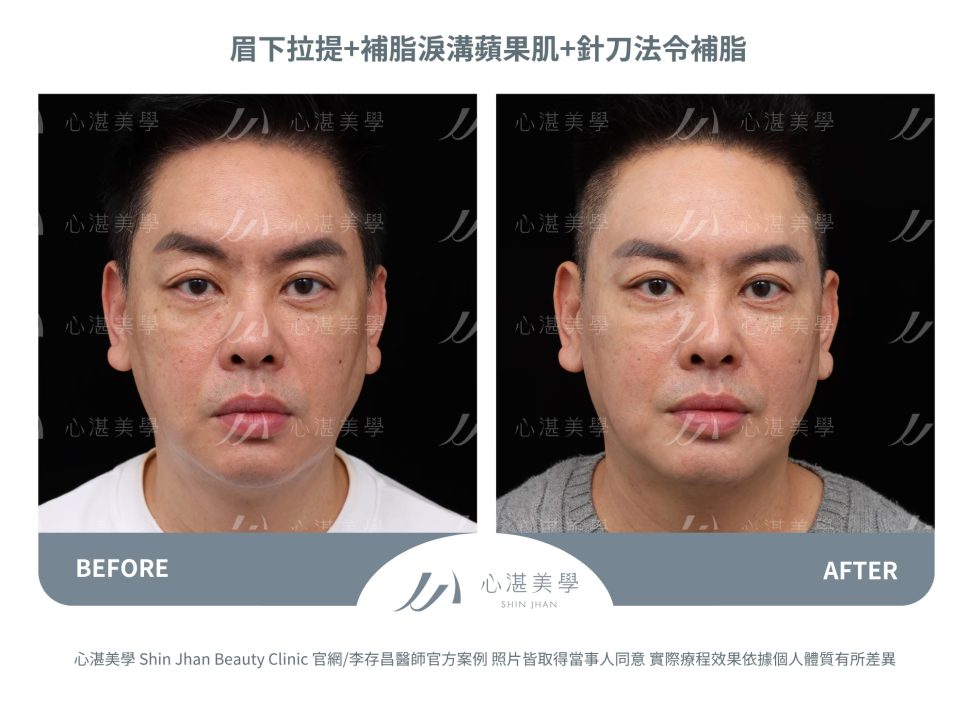 針刀無痕法令紋平滑術＋自體脂肪補淚溝＋微創提眉手術（眉下切）