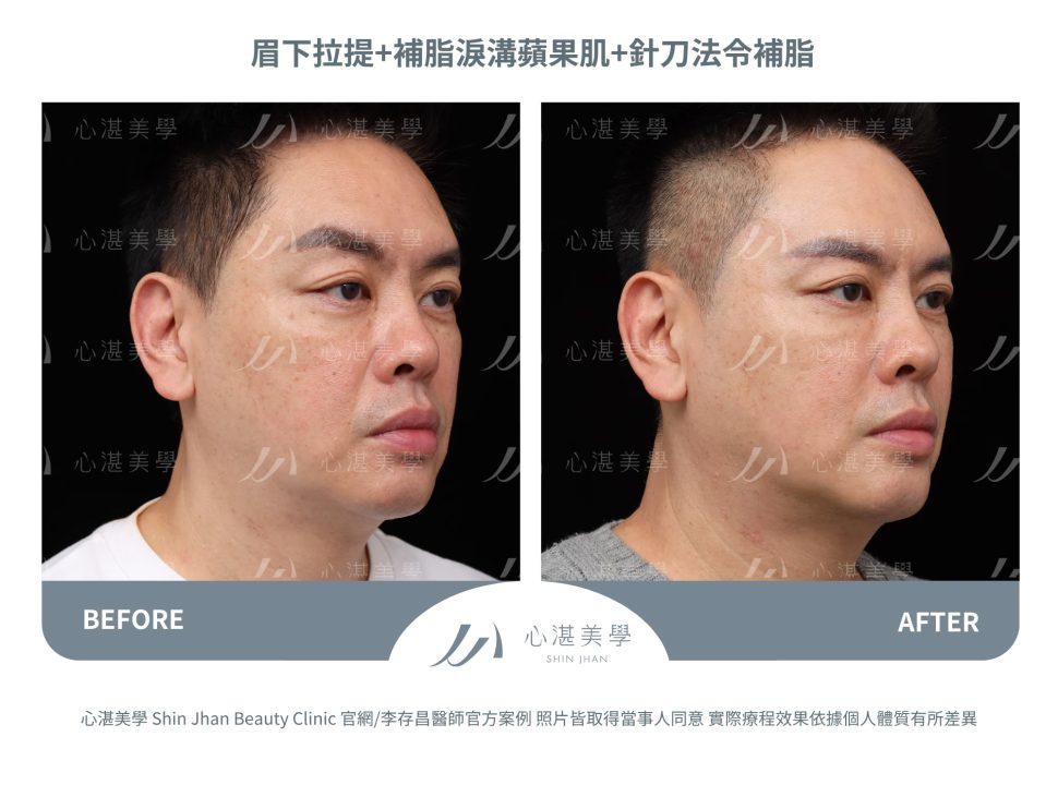 針刀無痕法令紋平滑術＋自體脂肪補淚溝＋微創提眉手術（眉下切）