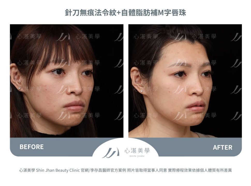 針刀無痕法令紋平滑術＋自體脂肪補唇珠＋縮唇