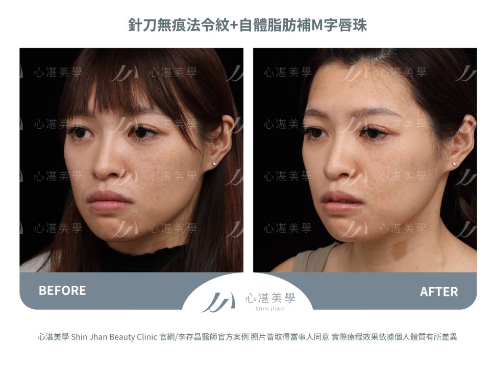 針刀無痕法令紋平滑術＋自體脂肪補唇珠＋縮唇