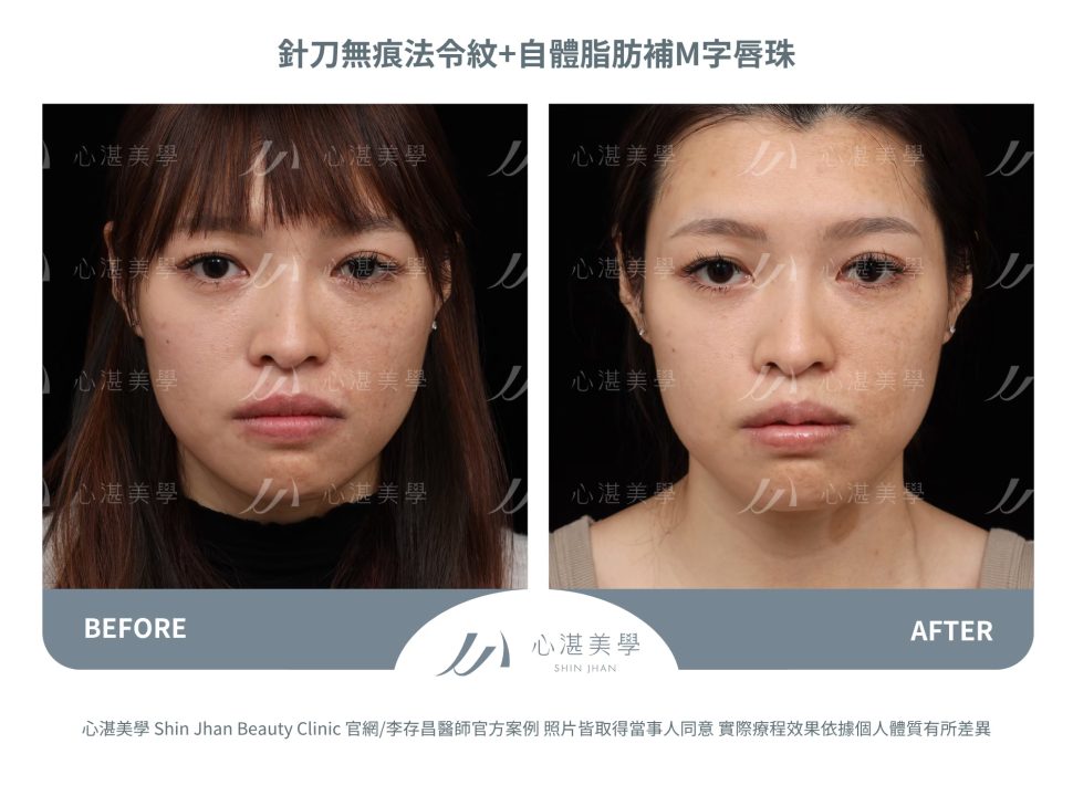 針刀無痕法令紋平滑術＋自體脂肪補唇珠＋縮唇