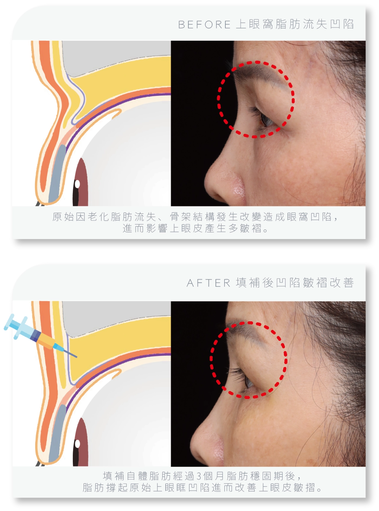 常見的解決上眼窩凹陷方式有哪些？