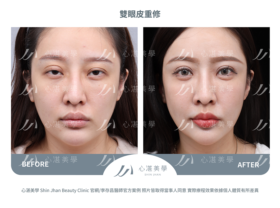 雙眼皮重修的常見原因:眼摺過寬或過窄、不自然肉條感 術前術後案例分享