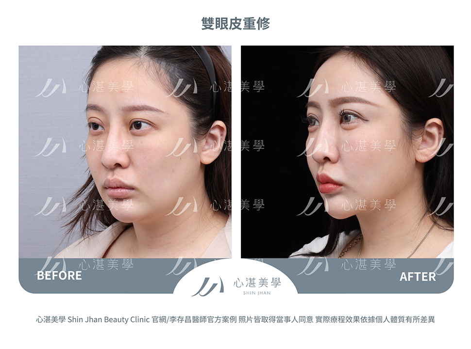 雙眼皮重修的常見原因:眼摺過寬或過窄、不自然肉條感 術前術後案例分享