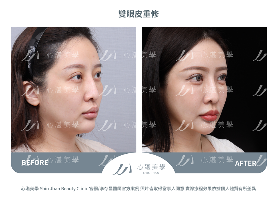 雙眼皮重修的常見原因:眼摺過寬或過窄、不自然肉條感 術前術後案例分享